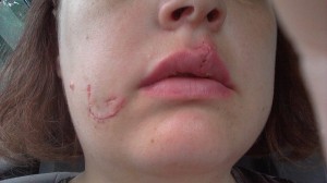 Facial scars